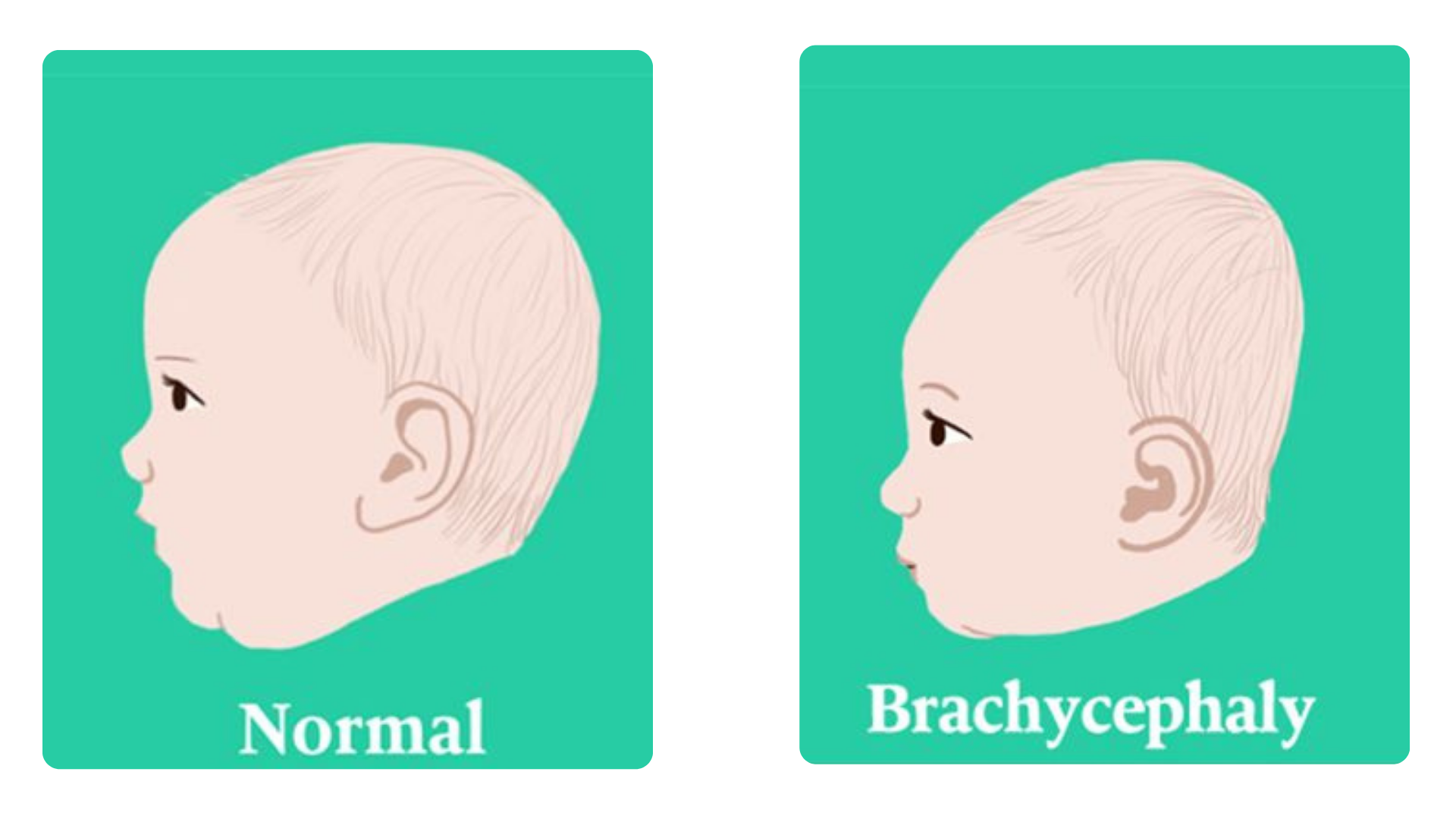 brachycephaly