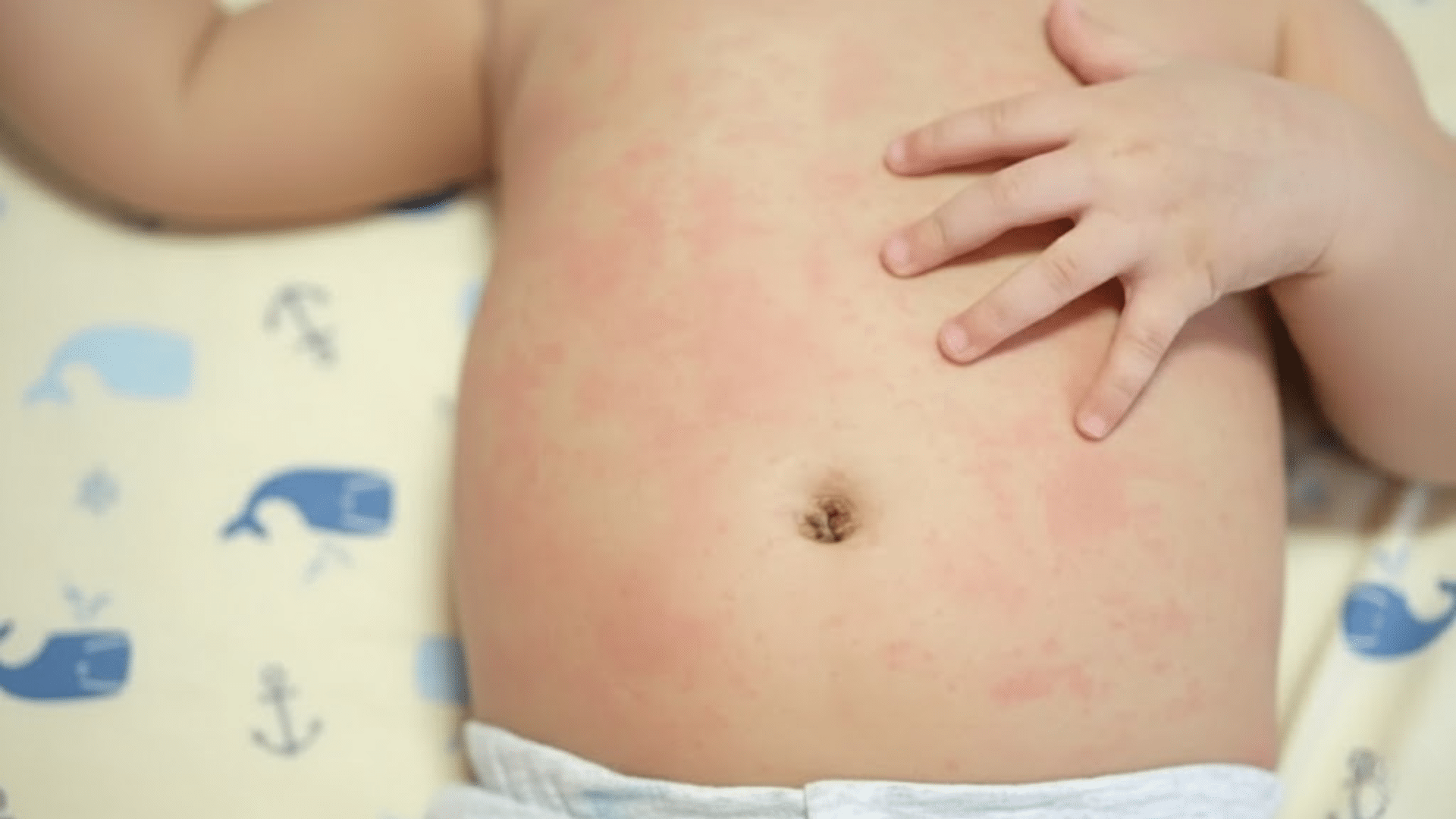 teething rash on the stomach